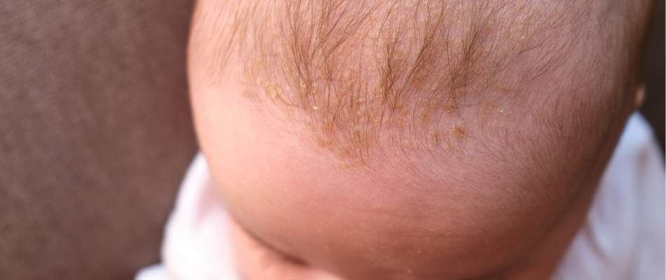 Nahaufnahme eines Babykopfes mit Milchschorf, einer krustigen Schicht auf der Kopfhaut. Das Baby trägt ein weißes Kleidungsstück.